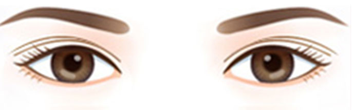 双眼皮修复
