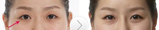 双眼皮修复